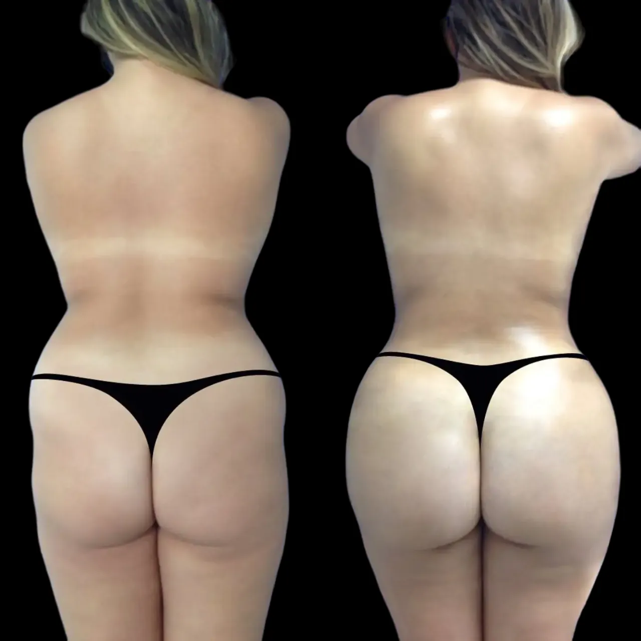 Hyacorp Fillers Treatment in Dubai: Smooth Results You’ll Love