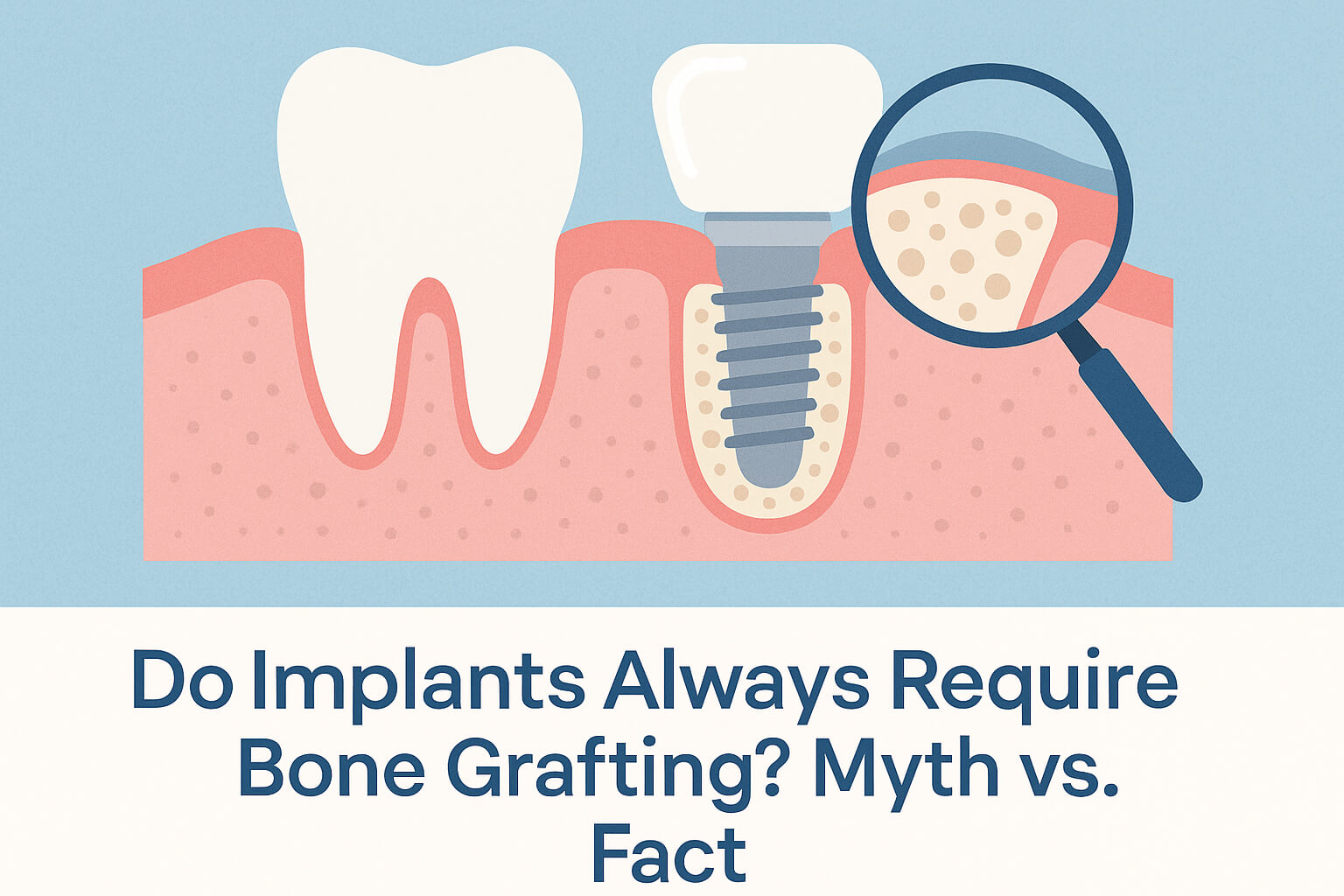 Do Implants Always Require Bone Grafting Myth vs. Fact