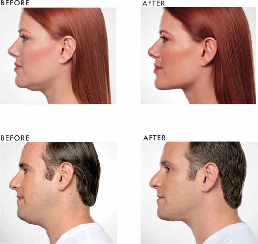 Fat Dissolving Injections