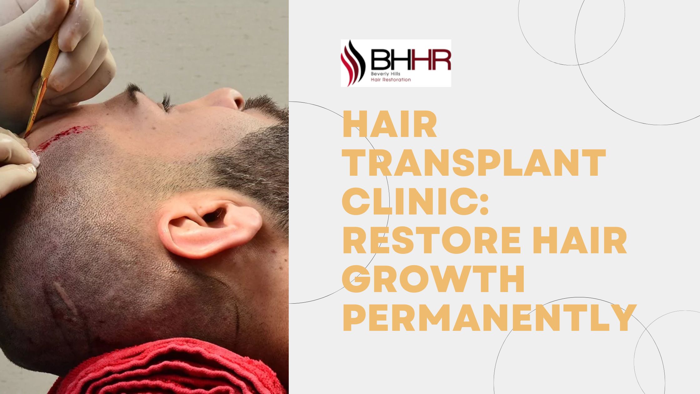 facial hair transplant