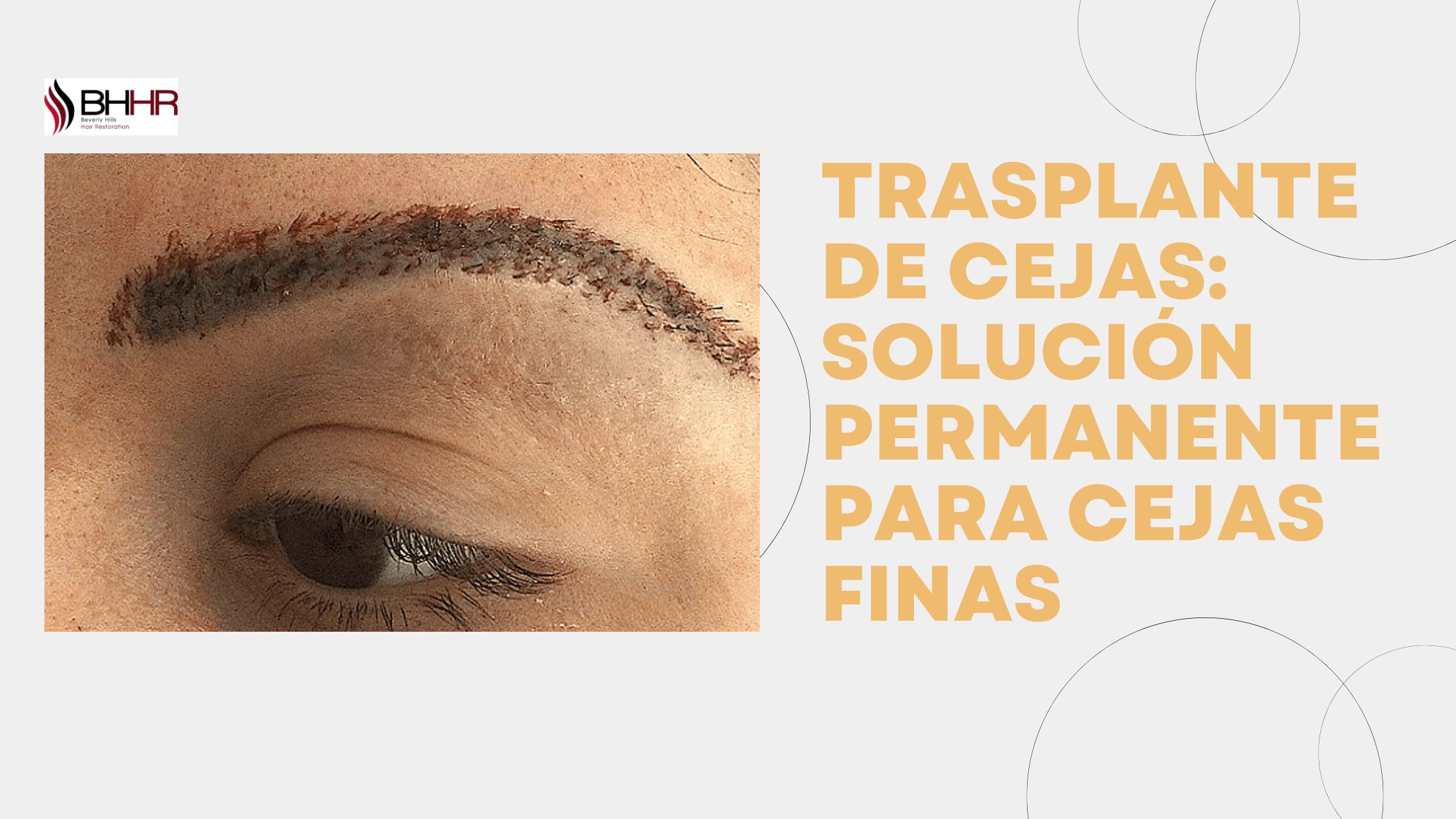 trasplante de cejas