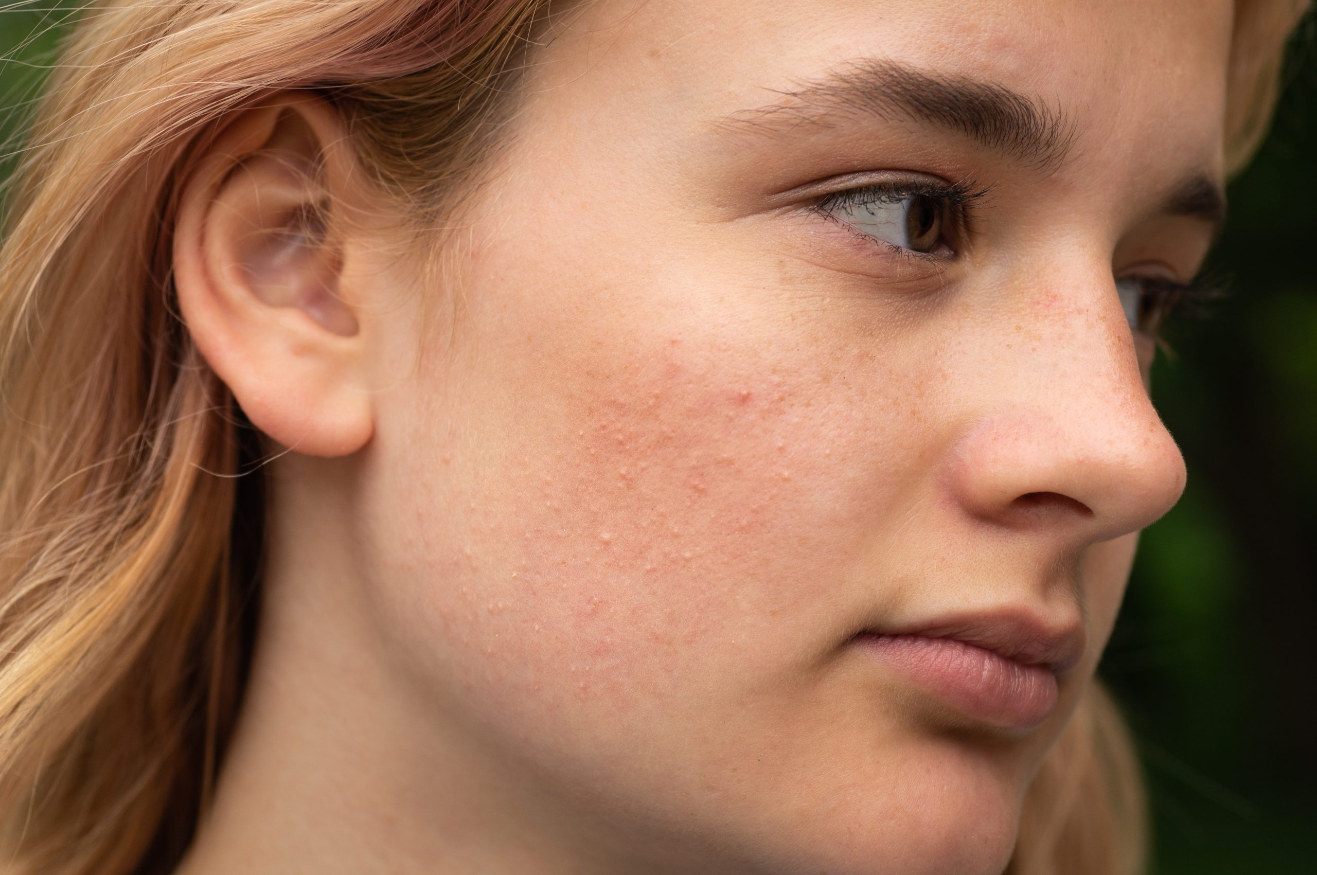 Close-up of a young woman with mild acne and textured skin before an acne facial Tysons Corner treatment.