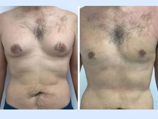 gynecomastia-in-dubai