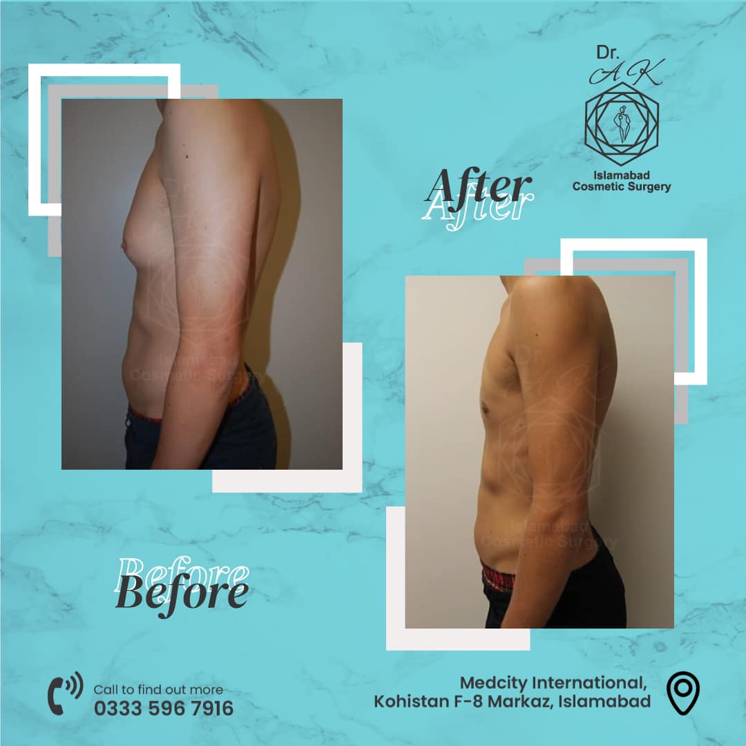 gynecomastia surgery cost in islamabad