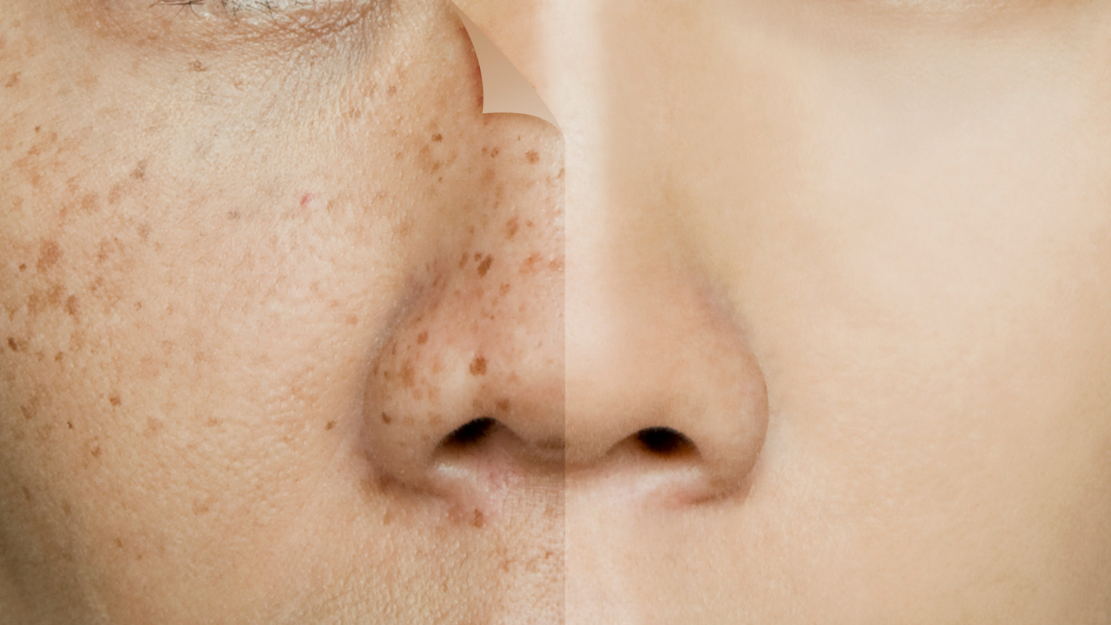 Close-up view of dark spots correction Chevy Chase MD showing reduced pigmentation on nose and cheeks.