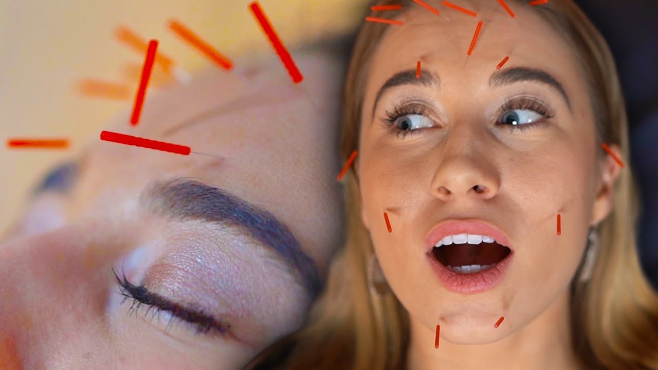  Acupuncture Face Lift 