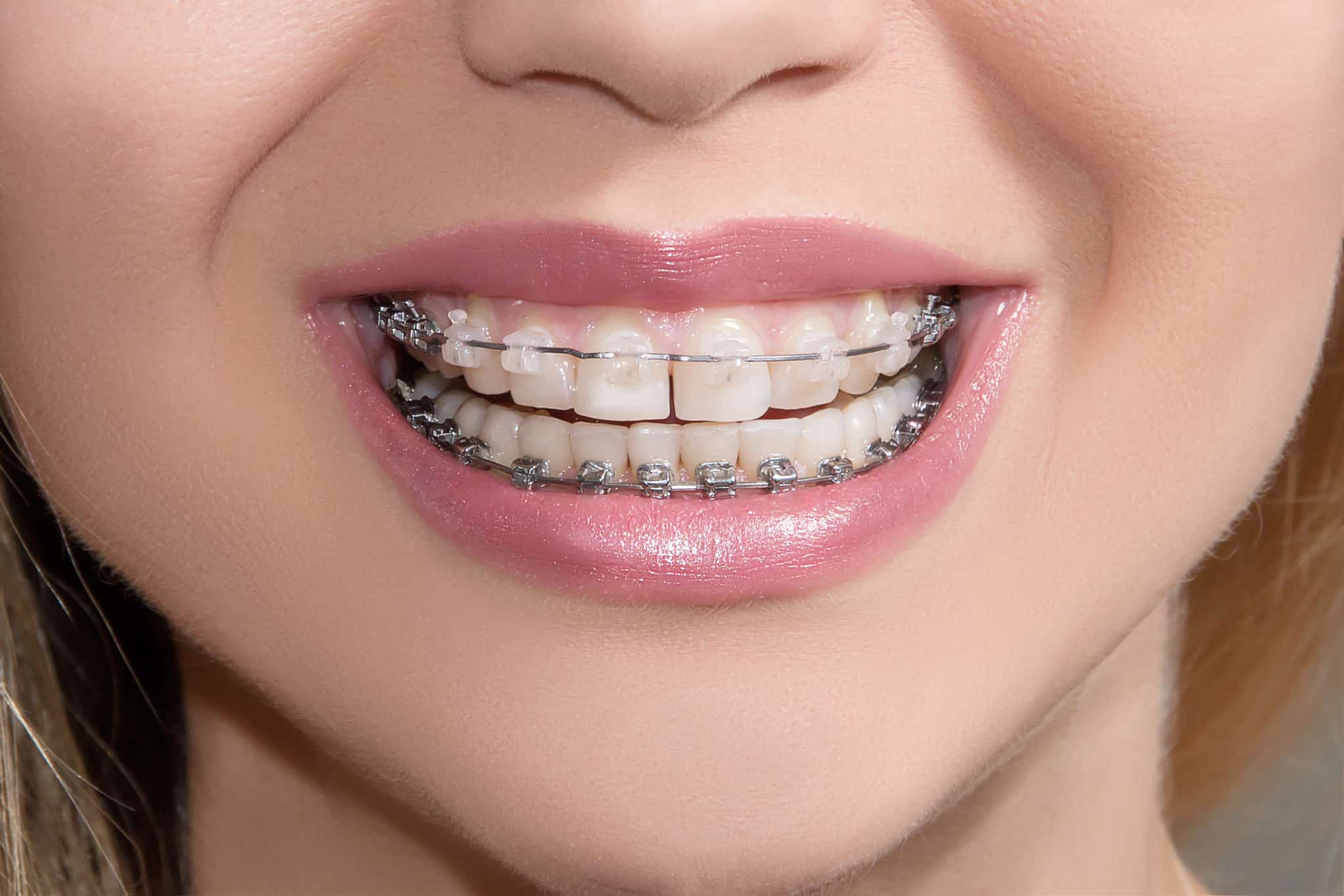 adult braces before and after