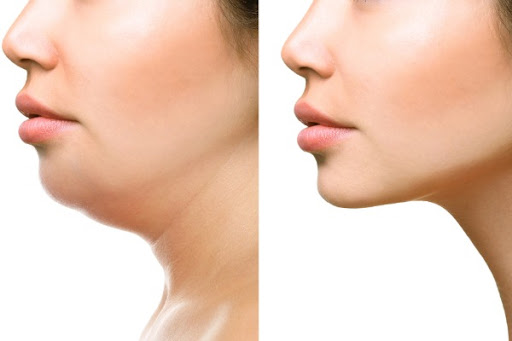Fat Dissolving Injections in London: Aqualyx & Double Chin Removal