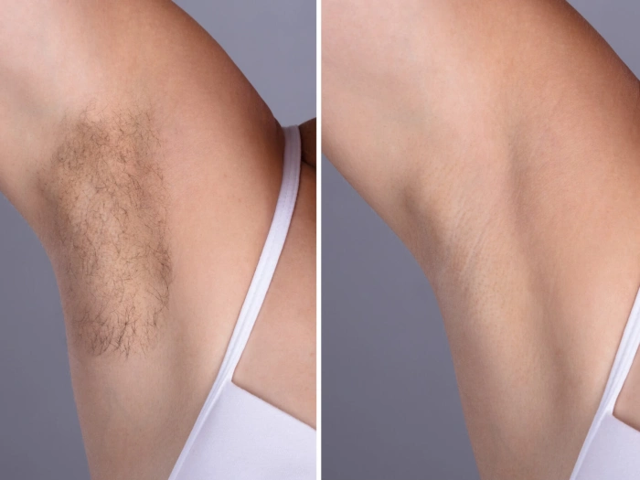 Best Plastic Surgeon in dubai for Men’s Laser Hair Removal